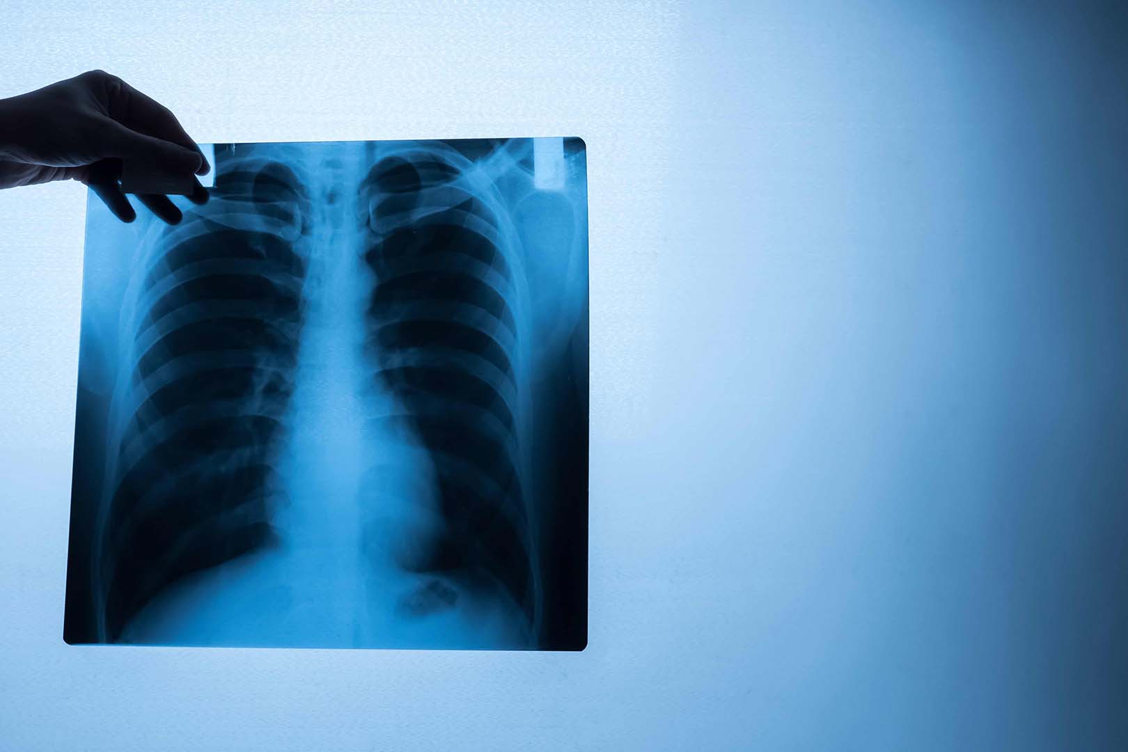 pneumonia x ray