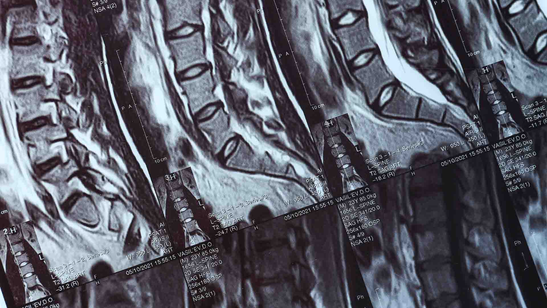 espresonancia magnetica lumbar