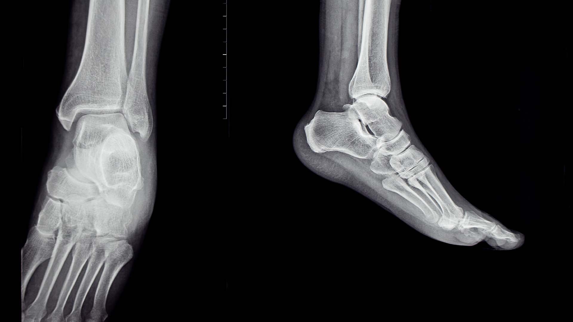 Ankle MRI
